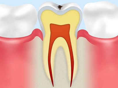 初期の虫歯（CO）