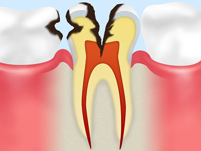 神経に達した虫歯（C3）